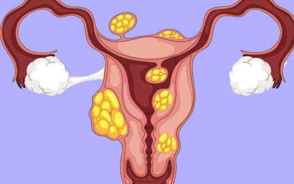【选择供精考虑哪些因素】子宫肌瘤会导致女性不孕,若月经量多就得小心了